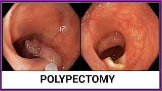 POLYPECTOMY  পলিপেকটমি BDENDOSCOPY [upl. by Rorke]