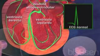 ¿Por qué se produce la taquicardia ventricular [upl. by Annayd67]