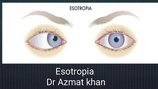 Esotropia part 2 [upl. by Parrish]