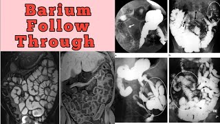 Barium Follow Through Complete Study [upl. by Huba]