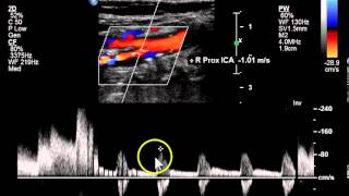 Bilateral ICA amp Unilateral Subclavian Stenosis  Case Study [upl. by Aiciles589]