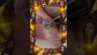 Blackheads Removal  Acne Treatment and Very Satisfying Satisfying Pimple pop blackheads [upl. by Ellinej931]