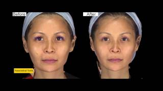 Ellanse procedure at ShangLi Dermatologic amp Aesthetic Clinic [upl. by Fraze577]