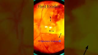 Diabetic retinopathy  Hemorrhages  Hard exudates  Fundus  Short Video 188 [upl. by Avik616]