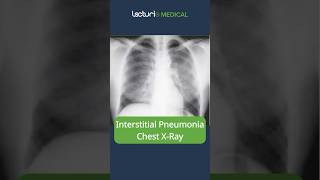 Understanding Interstitial Pneumonia 🫁 MedicalEducation usmle [upl. by Isidore]