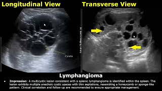 Spleen Ultrasound Reporting  Splenic Disease Scan Reports  How To Write USG Report  Abdominal USG [upl. by Rurik777]