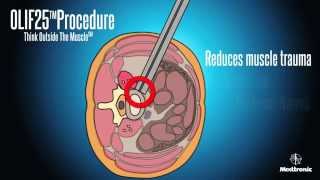 OLIF25 animation 斜側前脊椎融合手術 oblique lumbar interbody fusion Minimal invasive 微創腰椎融合手術 [upl. by Yajiv160]