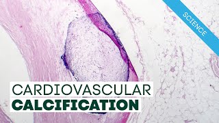 Vitamin K2 and Cardiovascular Calcification [upl. by Dadinirt729]