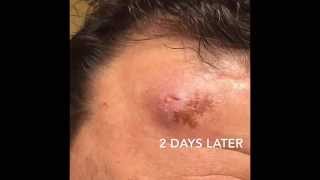 Spider Bite in Clearwater Fla  Cobys Termite and Pest Control [upl. by Iniretake]