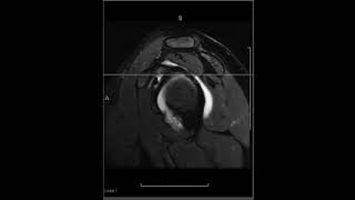 Shoulder Arthrography  Sublabral Foramen and Buford Complex [upl. by Hcab6]