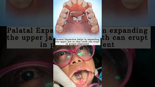 How Palatal Expander Work amp Benefits 🤩👆🏻 specialneedsdentistry shorts youtubeshorts [upl. by Eustis]