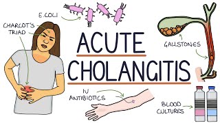 Understanding Acute Cholangitis Ascending Cholangitis [upl. by Rolyks120]