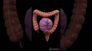 Understanding Colon Volvulus A Twist in the Digestive Tale [upl. by Zellner]