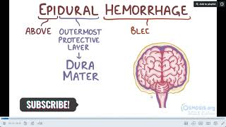 EPIDURAL HEMATOMA Pathology CNS mednex osmosis [upl. by Elke]