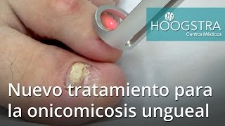 Nuevo tratamiento de onicomicosis ungueal con láser Lotus y Helios 16041 [upl. by Amsed727]