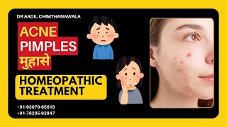 मुहासे  Acne  PIMPLES  Best Homeopathic Treatment  Dr Aadil Chimthanawala  Skin Complaints [upl. by Pedersen530]