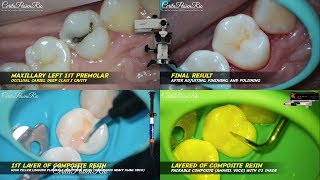 occlusal cavity restoration composite resin grandioso heavy flow amaris voco premolar [upl. by Margie]