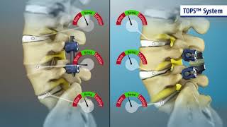 Animation comparing the TOPS device to lumbar fusion with subtitles [upl. by Wimsatt222]