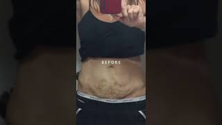 FasciaBlasting STOMACH Before and After [upl. by Ayerf]