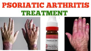 PSORIATIC ARTHRITIS TREATMENT [upl. by Ehtiaf]