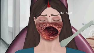 ASMR Animation treatment from infected mouth  2D Animation restasmr1 [upl. by Assyl]