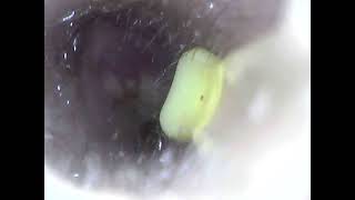 Extracción de cerumen impactado Perforación timpánica [upl. by Raymund535]