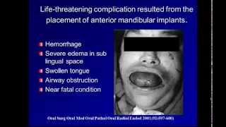 Complications in anterior implants [upl. by Ahsilak]