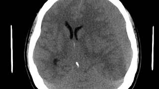 CNS C5 Bilateral acute SDH with mass effect [upl. by Brodench]