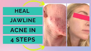 Jawline Acne  4 steps to clear cystic acne on your jawline naturally [upl. by River330]