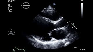 Ischemic Cardiomyopathy 2D Echocardiogram [upl. by Galatea]