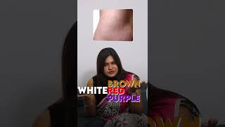 Can Stretch Marks Be Treated Here’s What You Need to Know  DrRadha Dermatology [upl. by Yllim753]