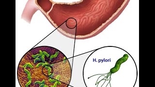 Helicobacter Pylori [upl. by Demetria]