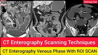 CT Enterography Scan Techniques in Hindi  How To do Ct Enterography Radiologydept ctscan ct [upl. by Nivak]