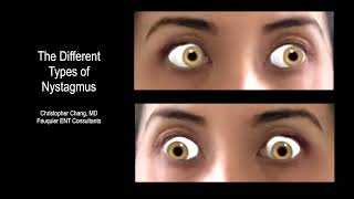 Types of Nystagmus Due to BPPV Vertigo What it Looks Like Which Side amp Which Maneuver [upl. by Atinor]