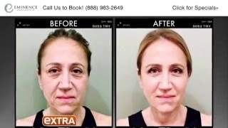 Ultherapy in Princeton NJ Treatment Demo Real Patient Before and After [upl. by Ahcilef]