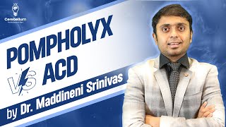 Pompholyx Vs ACD by Dr Maddineni Srinivas  Cerebellum Academy [upl. by Atsillac658]