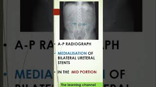 Spotter prepladder radiology radiologyresident neetpg neetpreparation marrow shortvideo [upl. by Camel]