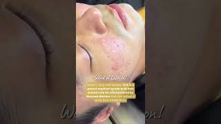 TCA Cross for Acne Scars [upl. by Enomrej486]