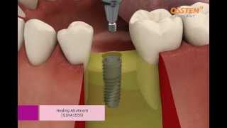 OSSTEM IMPLANT TSIII System Surgical Procedure Taper Kit and Straight Drill Kit [upl. by Einram791]