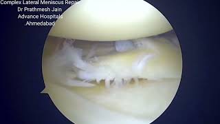 Complex lateral meniscus tear with flap [upl. by Zoie459]