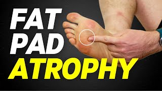 Fat Pad Atrophy  Heel Fad Atrophy and Ball of Foot Atrophy [upl. by Ewall]