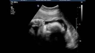 33 Week Ultrasound Scan [upl. by Ailugram]