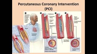 Atherosclerosis Angina Myocardial infarction✨ Full information💯 [upl. by Eda]