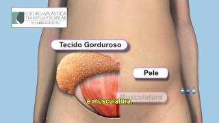 Como e realizado a cirurgia de abdominoplastia  Dr Fabricio Ribeiro [upl. by Garibold768]