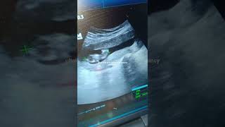 ultrasound of 11 weeks pregnancy with doppler [upl. by Crompton460]