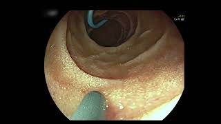 ERCP in Gastrojejunostomy bypass [upl. by Laband992]