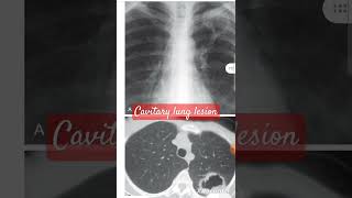 CT  X ray of cavitary lung lesion [upl. by Sonya]