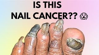 IS THIS NAIL CANCER symptoms  HOW TO IDENTIFY NAIL CANCER  SUBUNGUAL MELANOMA  MELANOMA [upl. by Sirtaeb952]