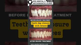 Teeth Gaps closure with Braces Invisalign treatment in vizag Dr Shiva prasad Orthodontist [upl. by Ferne572]