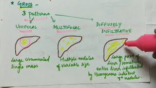 Hepatocellular Carcinoma HCC  Pathology  Handwritten notes [upl. by Eade393]